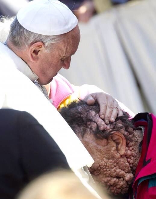 Pope Francis embraces horribly disfigured man