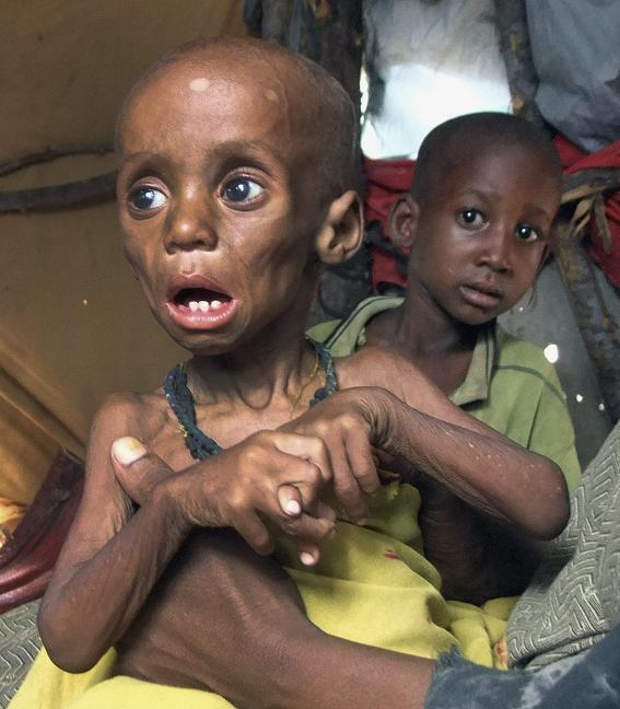 Ugandan Famine Victim