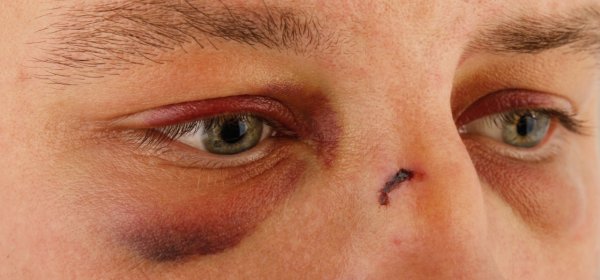 domestic-violence-male_black-eyes_molodec-shutterstock