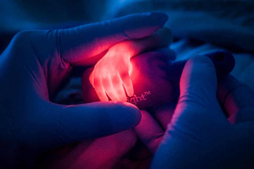 A nurse is looking for a vein on the hand of a premature baby. 