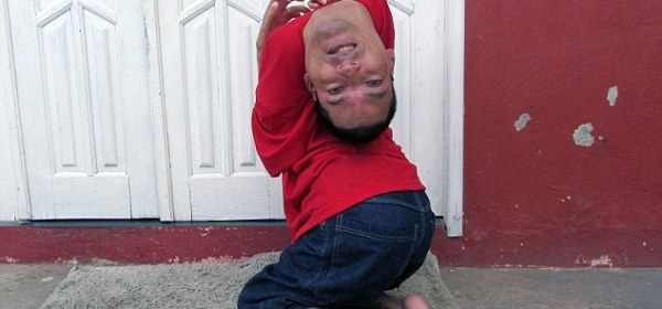 Man born with upside-down head defies doctors and becomes motivational speaker