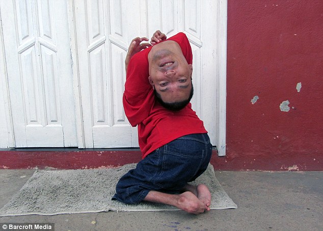 Man born with upside-down head defies doctors and becomes motivational speaker 