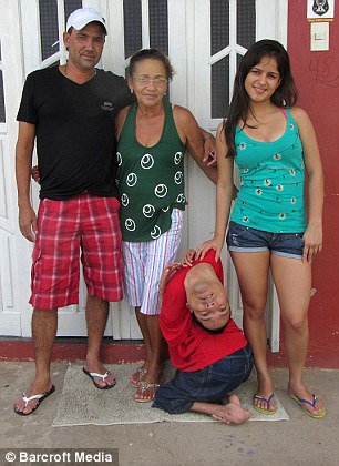 Man born with upside-down head defies doctors and becomes motivational speaker 