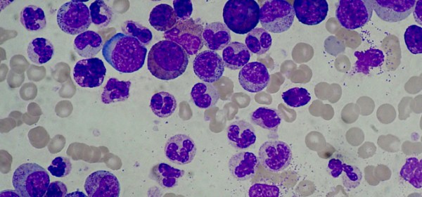 Chronic Myelogenous Leukemia