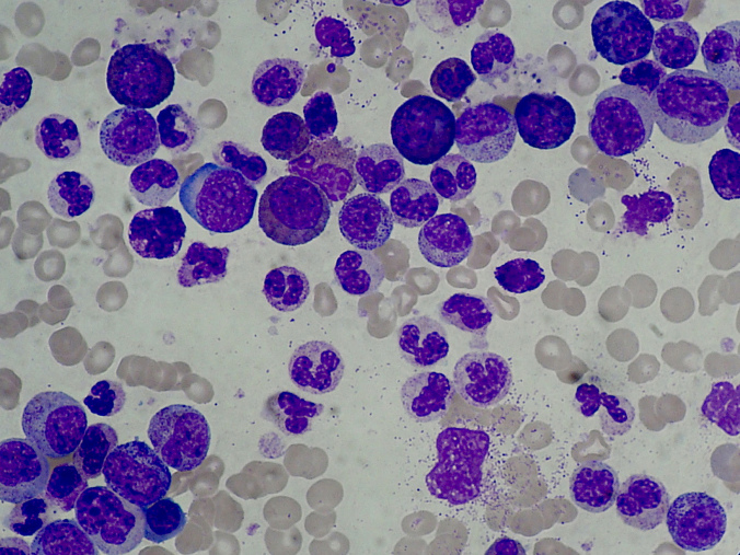 Chronic Myelogenous Leukemia